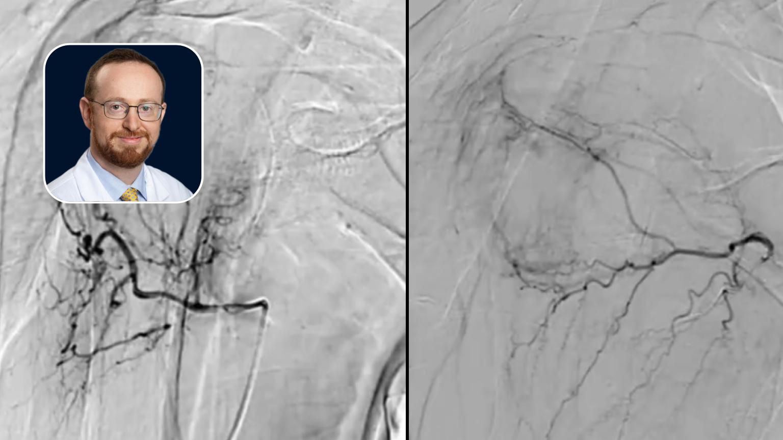 SAE: Severe Osteoarthritis of the Shoulder