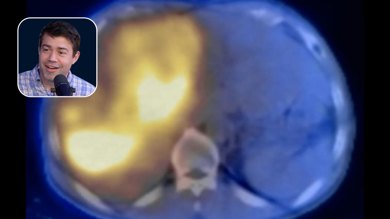 Y90: Treating a Large Tumor in a Hep B Cirrhosis Patient