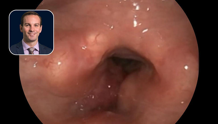 HNC: T3N0 Anterior Larynx Cancer with Erosion of Thyroid Cartilage Inner Table