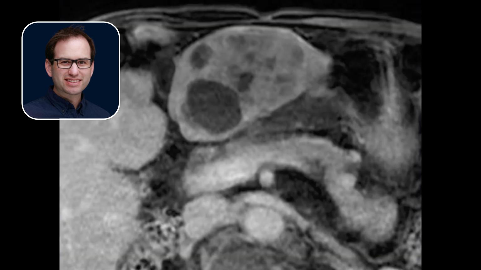 Y90 Radioembolization: Large Cholangiocarcinoma Treatment with Pressure-Enabled Delivery