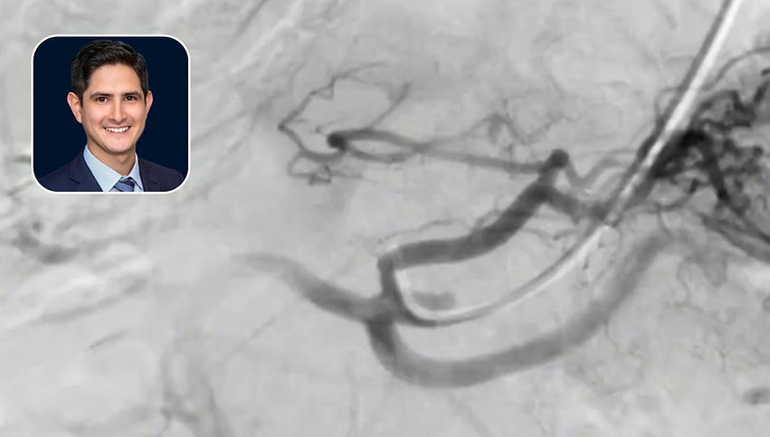 Arterial Trauma Embolization: LOBO Plug Applications in Y90 & GI Bleeding