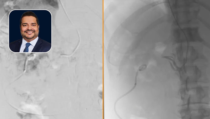 Embolization of a Renal Pseudoaneurysm from Nephrostomy Tube Dislodgement Using Liquid Embolic