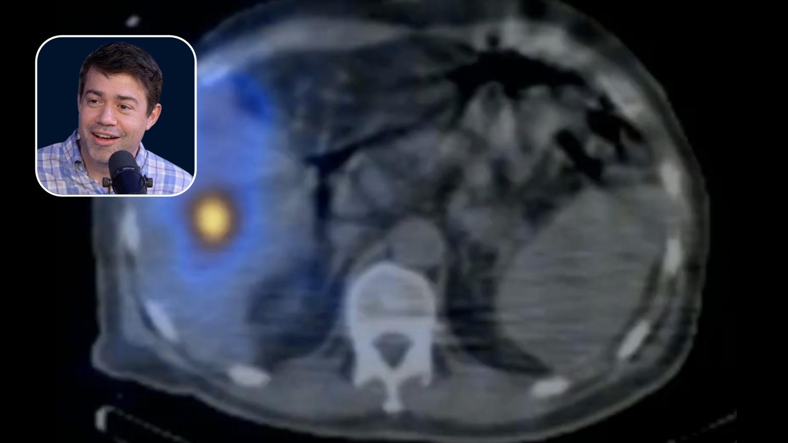 Y90: Radiation Segmentectomy Approaches & Outcomes in Hepatocellular Carcinoma Patients