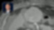 Y90 Radioembolization: Brachytherapy in a Large Liver Tumor Near the Stomach
