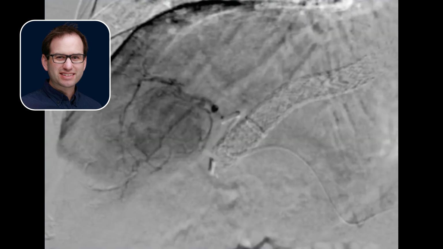TACE: Treating HCC in Decompensated Liver Cirrhosis (ALBI 3) with Microvascular Optimization