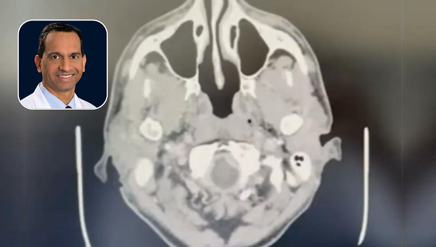 HNC: T4N2bM0 High Volume Primary Locally Advanced Head & Neck Squamous Cell Carcinoma