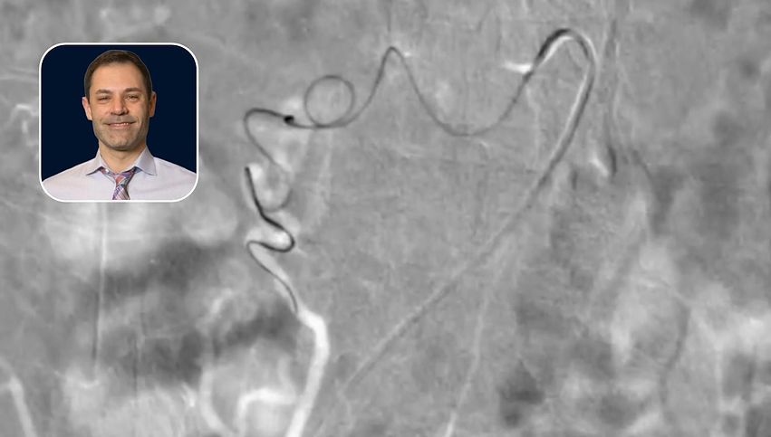 PAE: Variant Anatomy Wire Technique