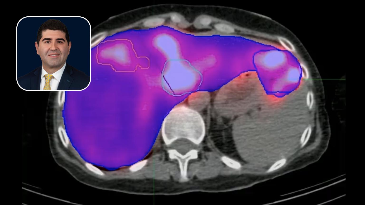 Y90: Hypovascular Metastatic Liver Lesions with History or Rectal Cancer