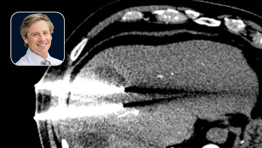 Liver Ablation: Switching from Y90 to Cryoablation to Treat an LR-5 HCC Tumor