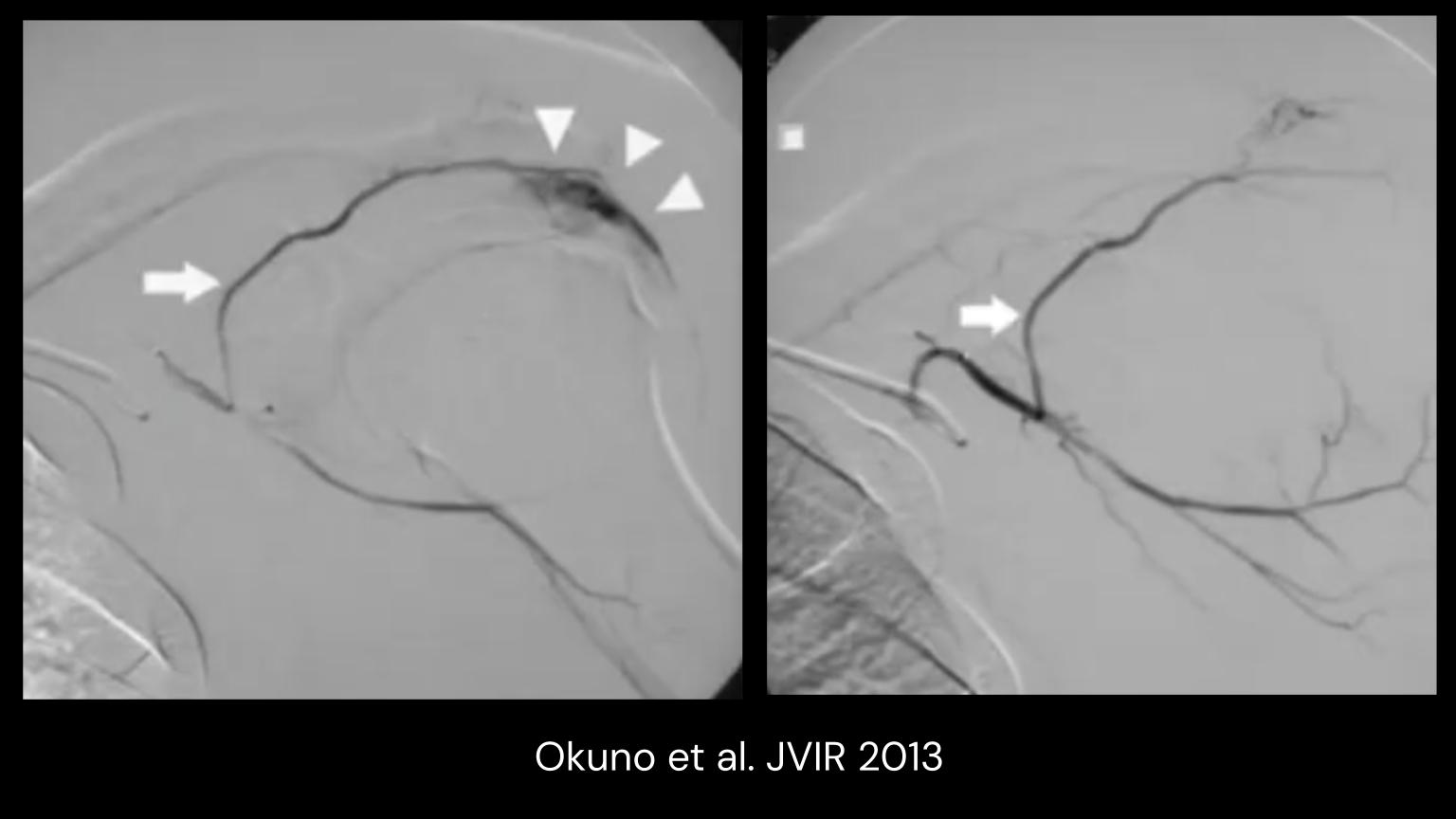 SAE: Adhesive Capsulitis Embolization Meta Analysis