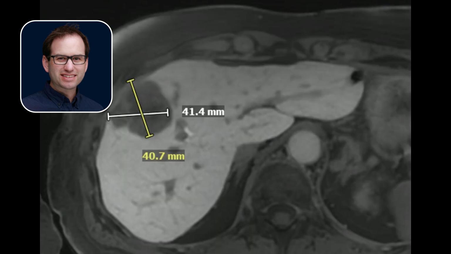 Y90: Metastastic Colorectal Cancer Mapping & Ablative Dose Strategies
