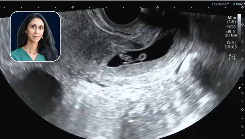 Clinical Insights on Ectopic Pregnancies