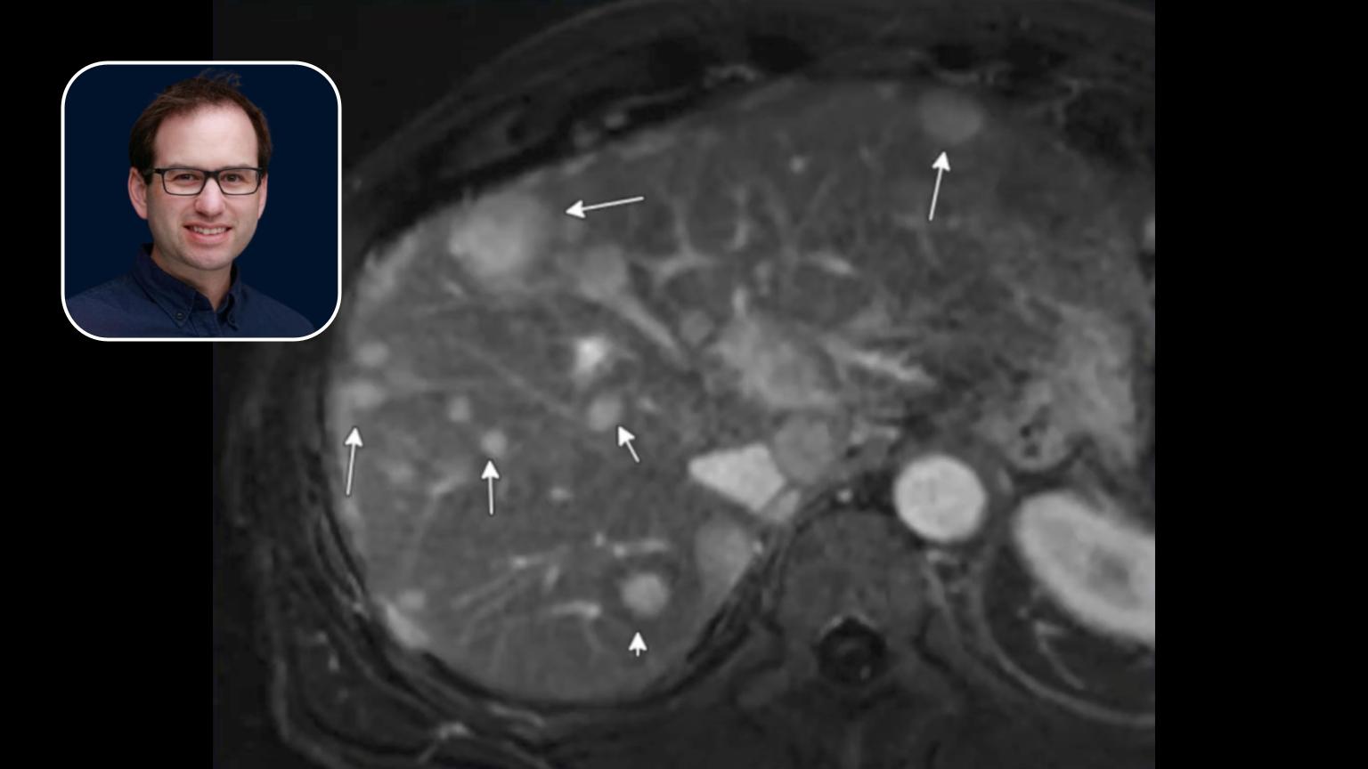 Y90 Radioembolization: Techniques for Treating Grade 3 Metastatic Neuroendocrine Tumor (NET)