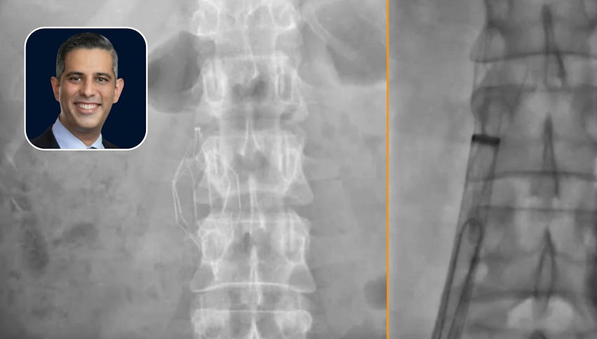 IVC Filter Removal: 36-year Old Female, OPTEASE Filter with Broken Struts