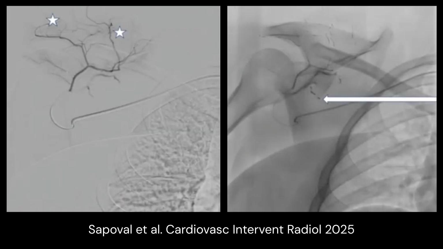 SAE: Relevant Shoulder Artery Anatomy