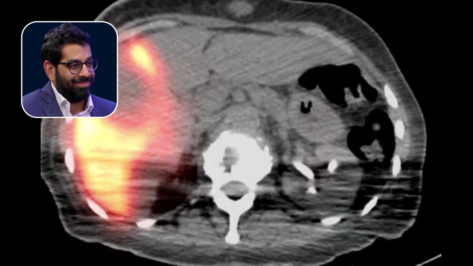 Y90: Challenging Multifocal Progressive mCRC Treated with Selective Dosing Techniques