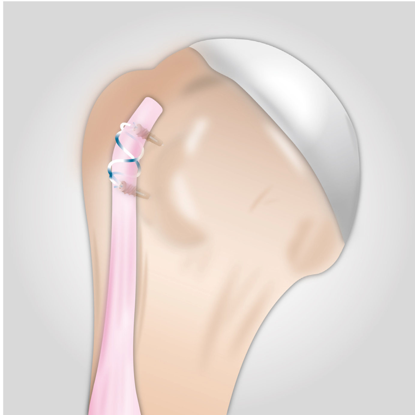 biceps tendon pain