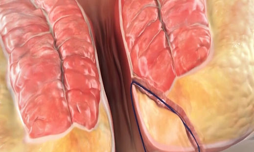 TREATMENT OF ANAL FISTULA TRACT WITH LASER ABLATION.jpg
