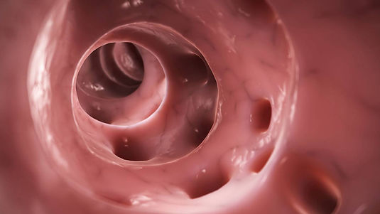 diverticulose.jpg
