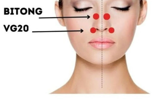 Agopuntura :rinite ,allergie stagionali,sinusite