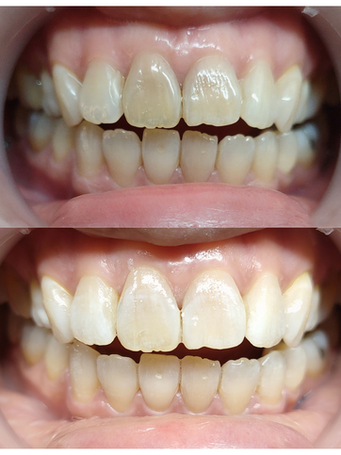 LED Teeth whitening treatment before and after 02