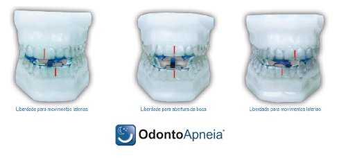 Odonto Apneia tratamento do ronco