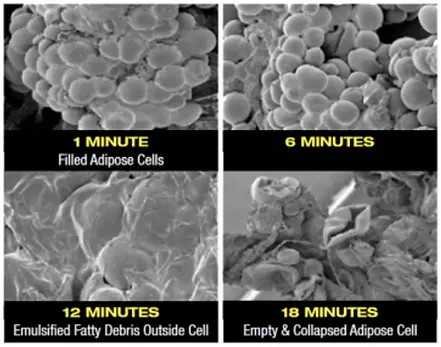 Fat Cell Destruction