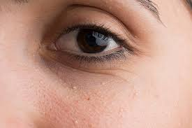 All about Those small white or yellowish and annoying bumps – MILIA! Understanding Causes, Treatments, and Home Remedies for These Tiny Bumps