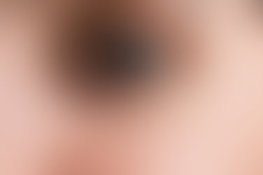 All about Those small white or yellowish and annoying bumps – MILIA! Understanding Causes, Treatments, and Home Remedies for These Tiny Bumps