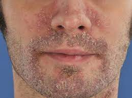 Dandruff vs. Seborrhoeic Dermatitis Scalp Psoriasis Symptoms How to Treat Flaky Scalp Dermatologist for Scalp Conditions Scalp Care