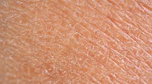 Dry skin, xerosis, atopic dermatitis, senile xerosis, diabetes, thyroid, skin hydration, phytoceramides, dust mite control, staph infections, skin care