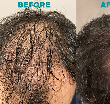 Before-and-after-PRP-hair-treatments