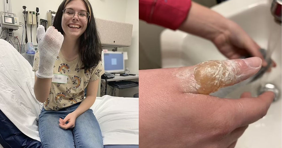 La receta de “cera casera” de TikTok que causó quemaduras en la mano de una joven