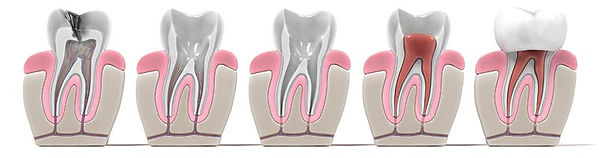 Dents infectées