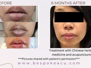 Holistic Healing for Exfoliative Cheilitis: A Traditional Chinese Medicine Perspective