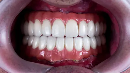 MH Dental China All-on-4 implant
restoration