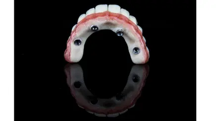 MH Dental China All-on-4 implant
restoration
