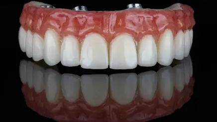 MH Dental China All-on-4 implant
restoration