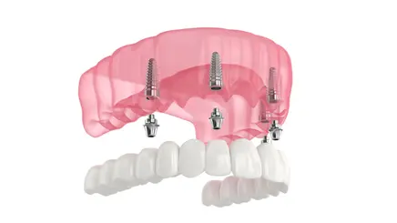 MH Dental China All-on-4 implant
restoration