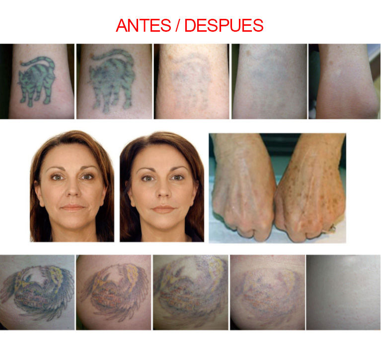 Miniatura: Anle Laser FG 2010 Nd YAG 1000 MJ