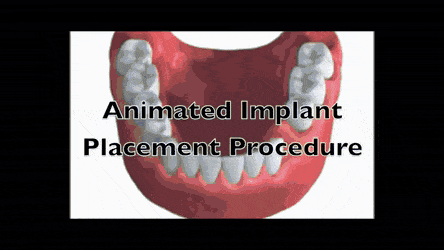 Implant placement.gif