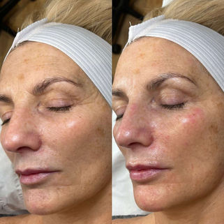 Facial treatment before and after