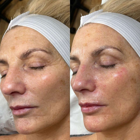 Facial treatment before and after
