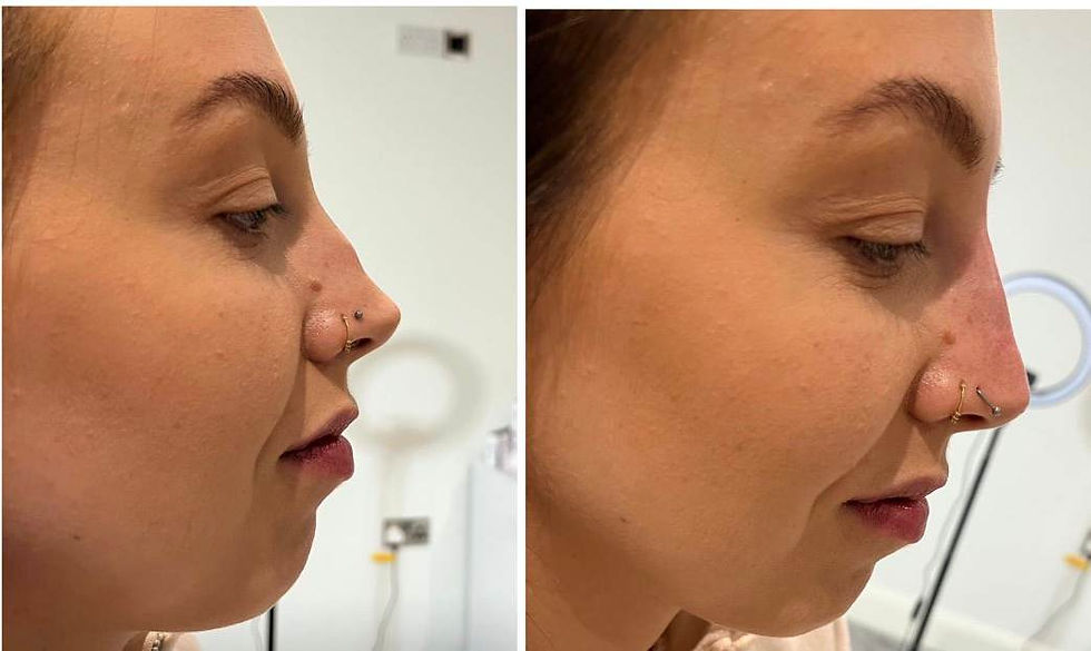 Before and after photo of dermal filler client