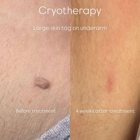 Cryotherapy skin tag treatment results