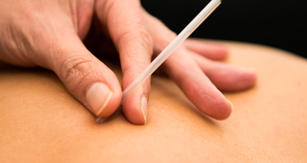 Dry Needling