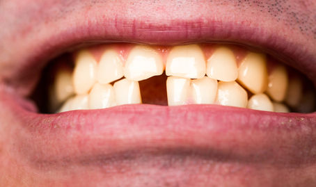 How to Replace a Missing Tooth: Explained Best Options