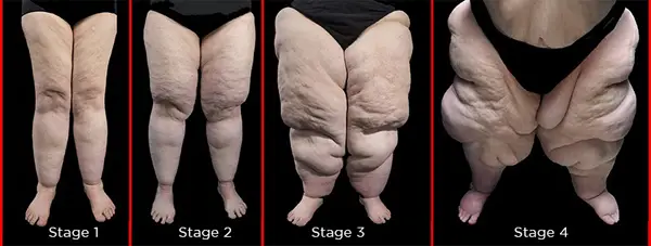 Lipedema Stages