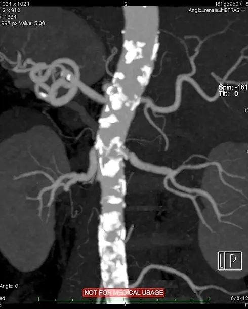 Ipertensione renovascolare aterosclerotica.webp