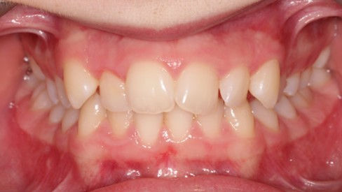 fogszabályozás kecskemét előtte 2 dr szabó georgina (2).jpg